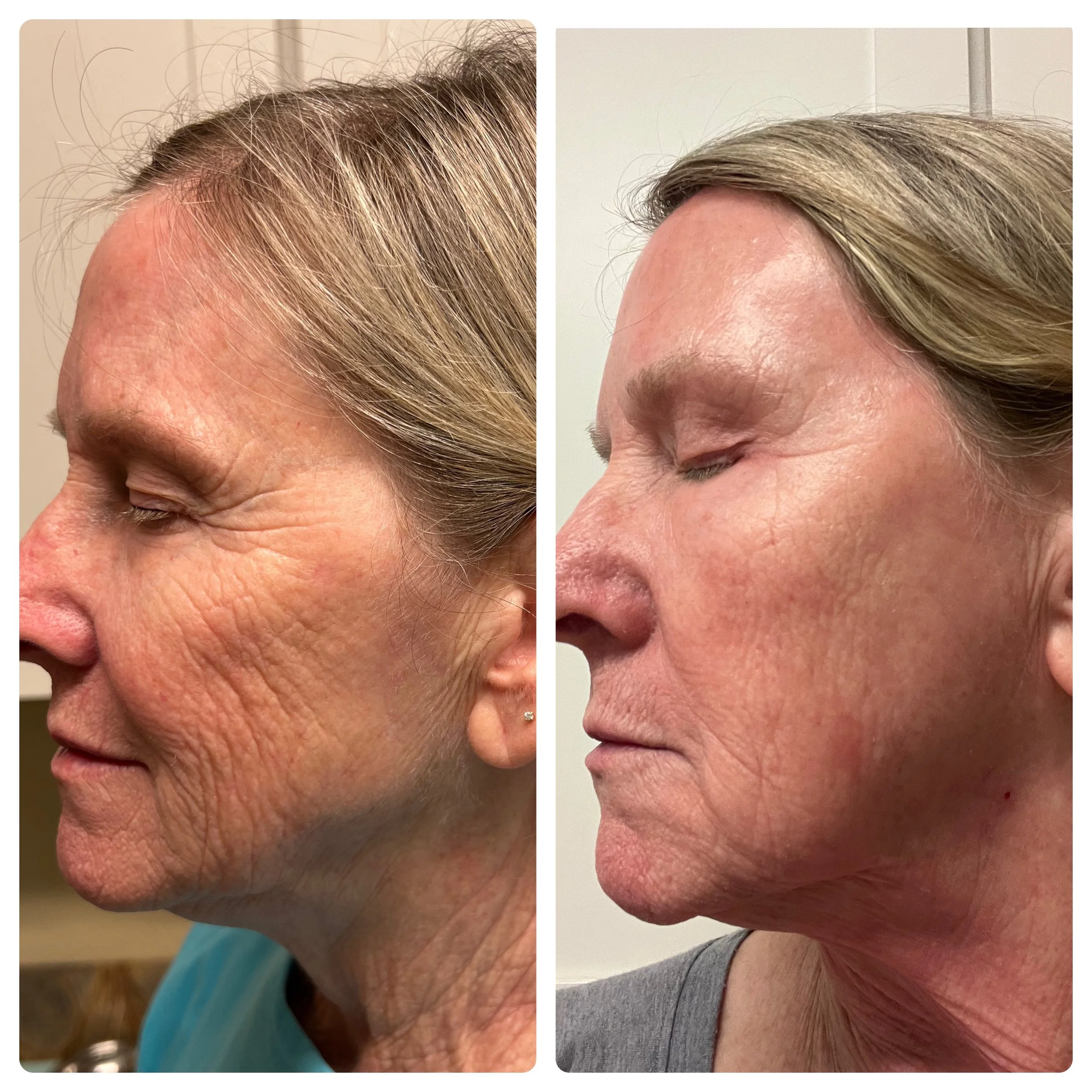 zo-skincare-regimen-before-after-dripping-springs-austin-tx