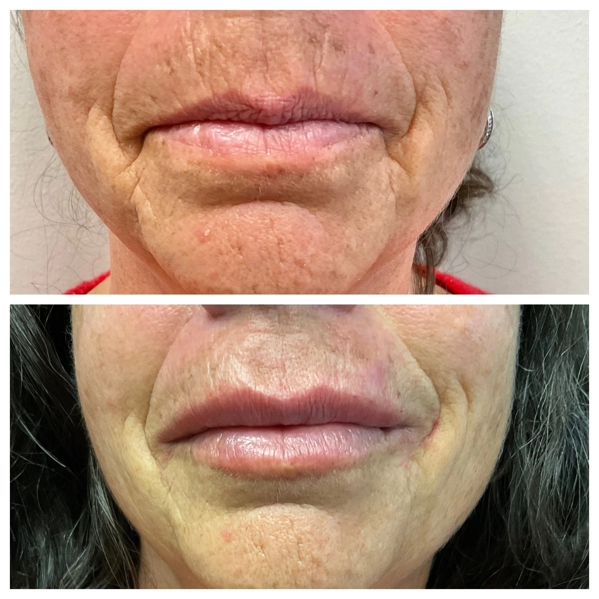 mouth-rejuvenation-lip-filler-before-after-dripping-springs-austin-texas