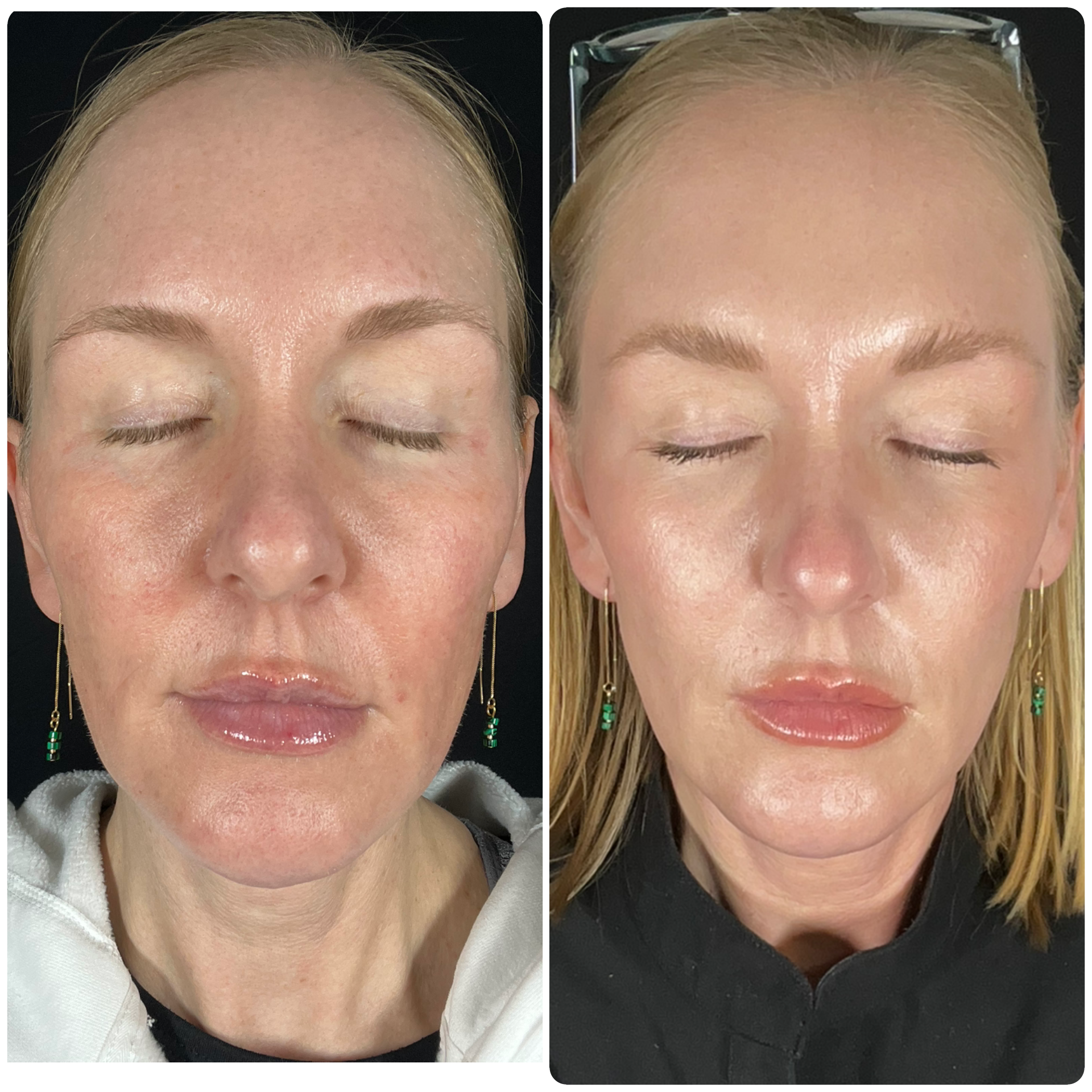 zo-chemical-peel-before-after-dripping-springs-austin-texas