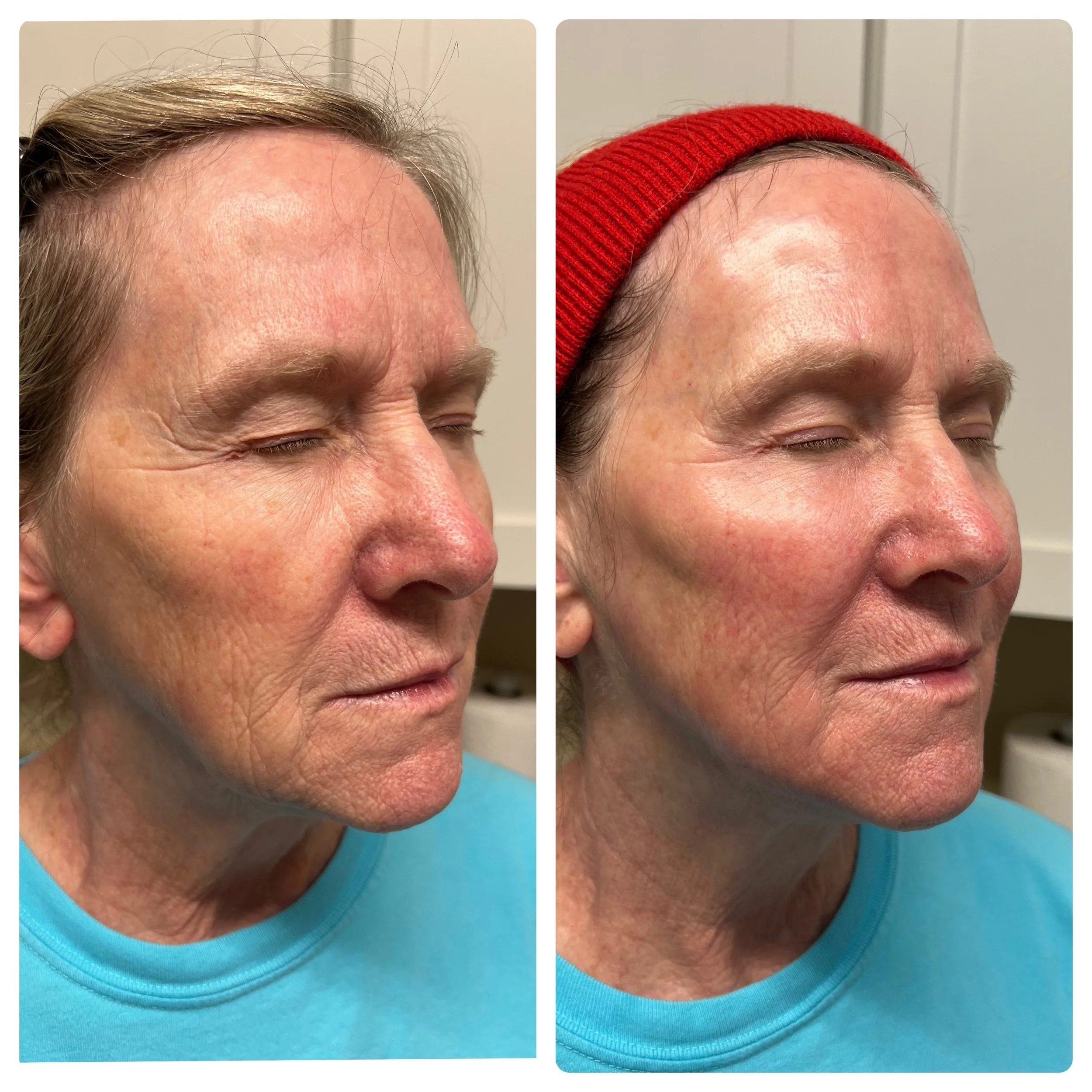 sculptra-before-after-dripping-springs-austin-texas