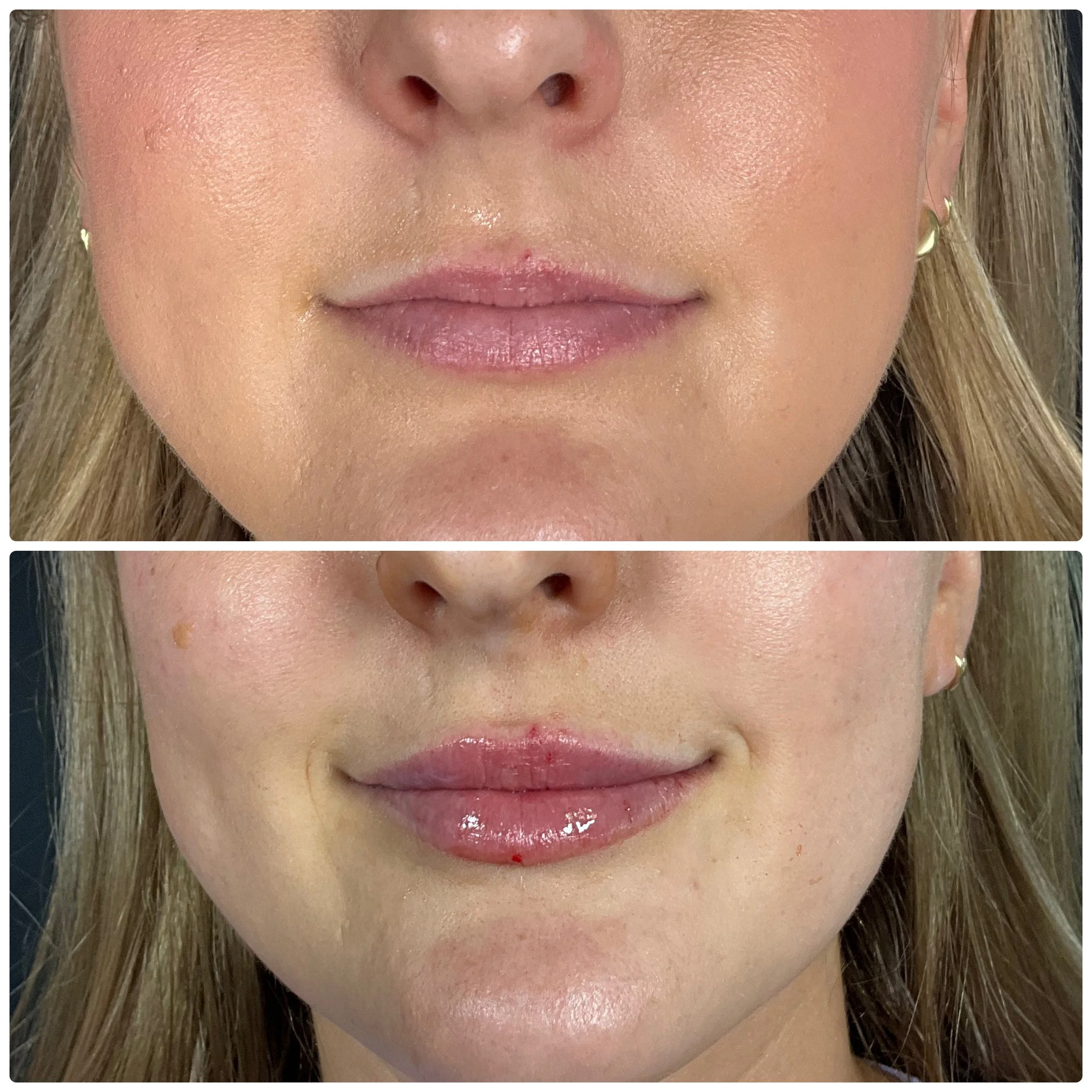 lip-filler-before-after-dripping-springs-austin-texas
