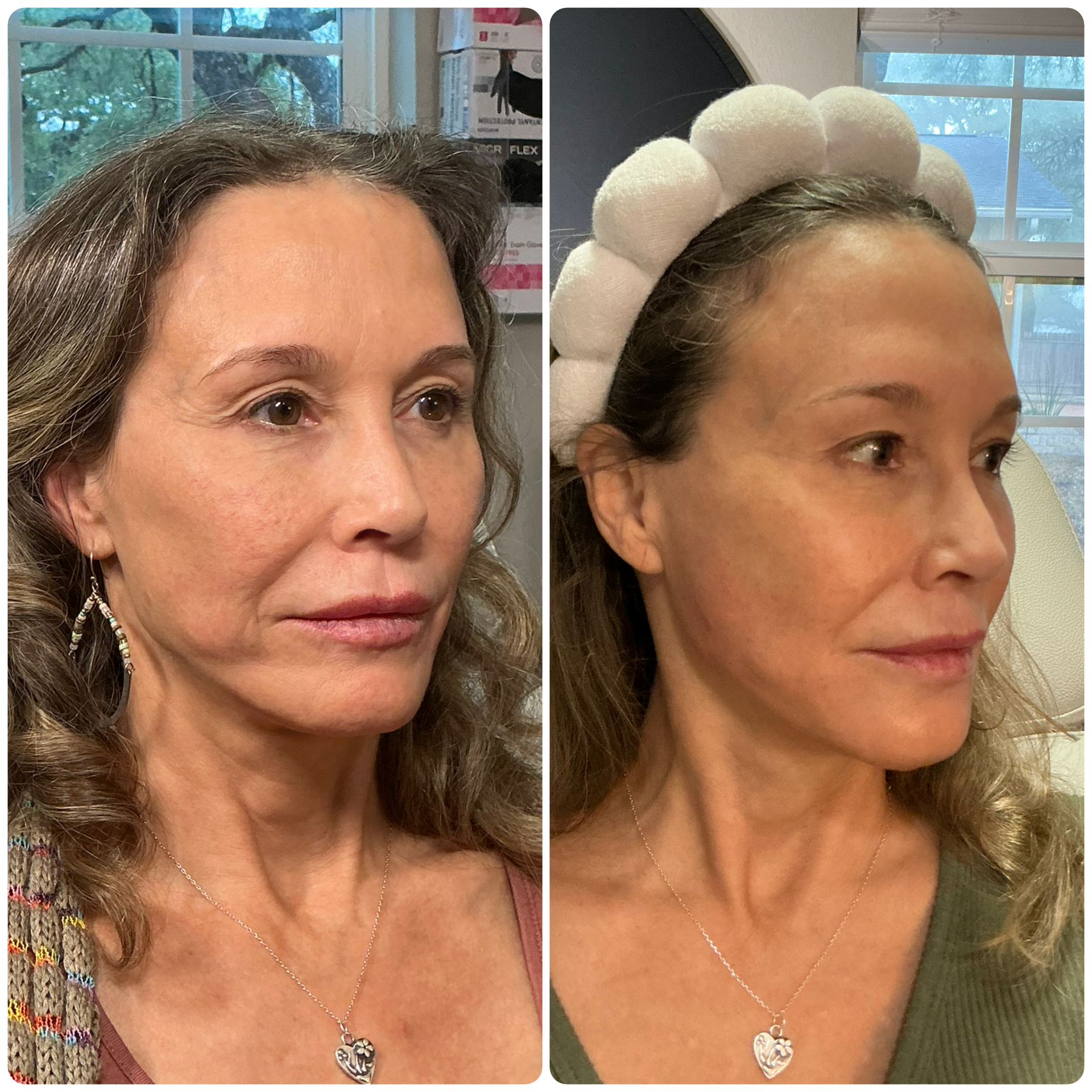 sculptra-before-after-dripping-springs-austin-texas