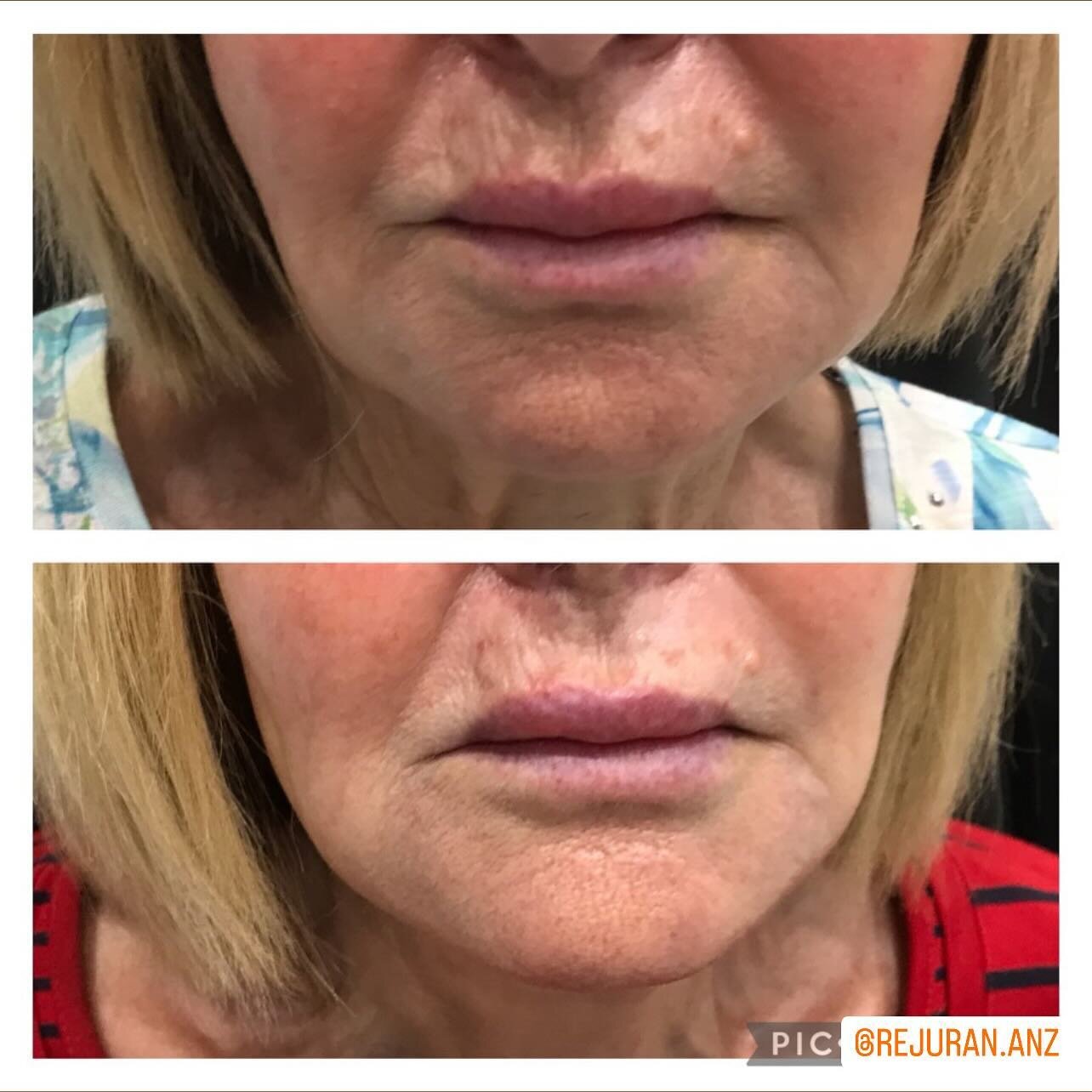 Before and after one Rejuran ( salmon DNA) treatment. Patient wanted to target fine lines around and under the lip area and a brighter more even skin tone without using fillers . More after photos to follow post second session #drninos #salmondna #re
