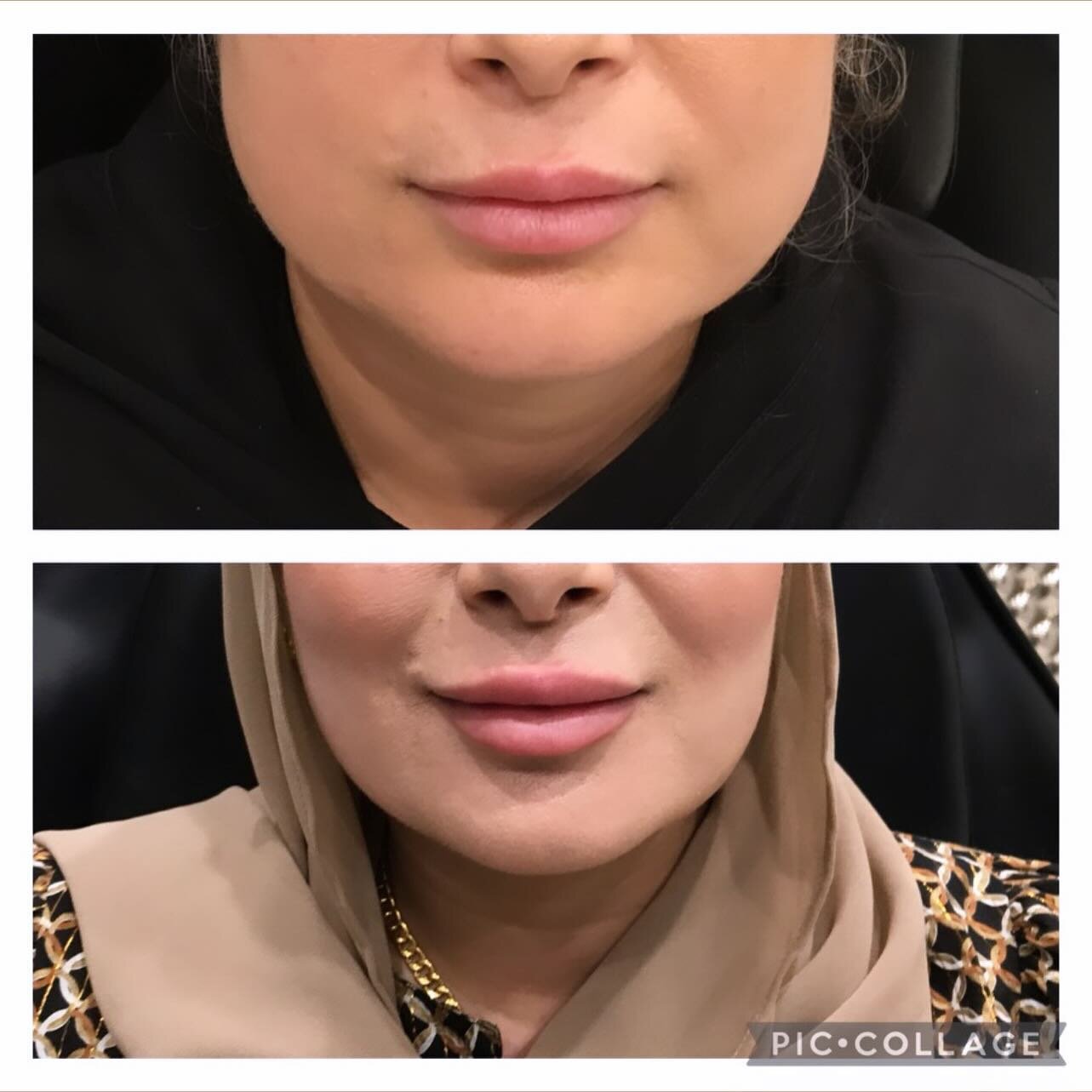 Lower face slimming /masseter injections , before and after plus some lip enhancement #drninos #masseterslimming #masseterreduction #lowerfaceslimming