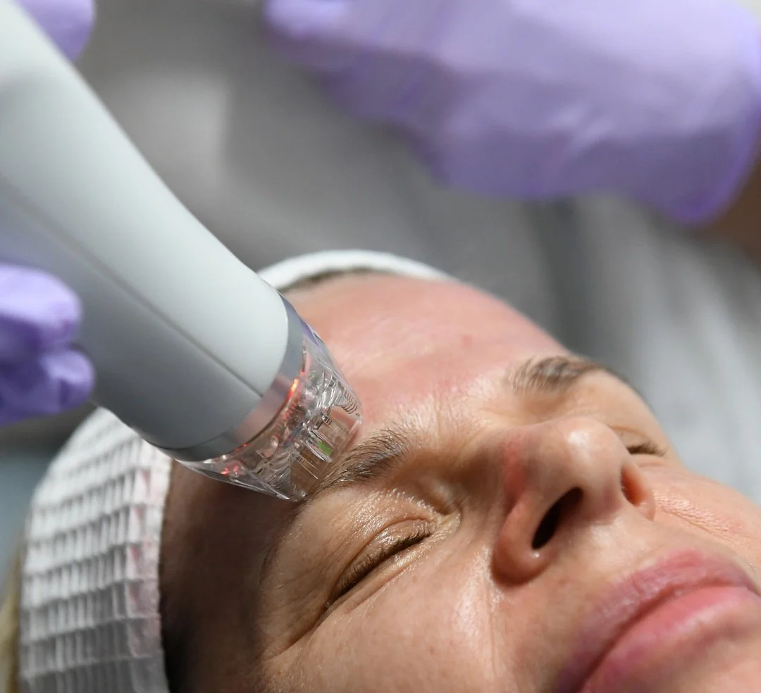 Secret RF Microneedling