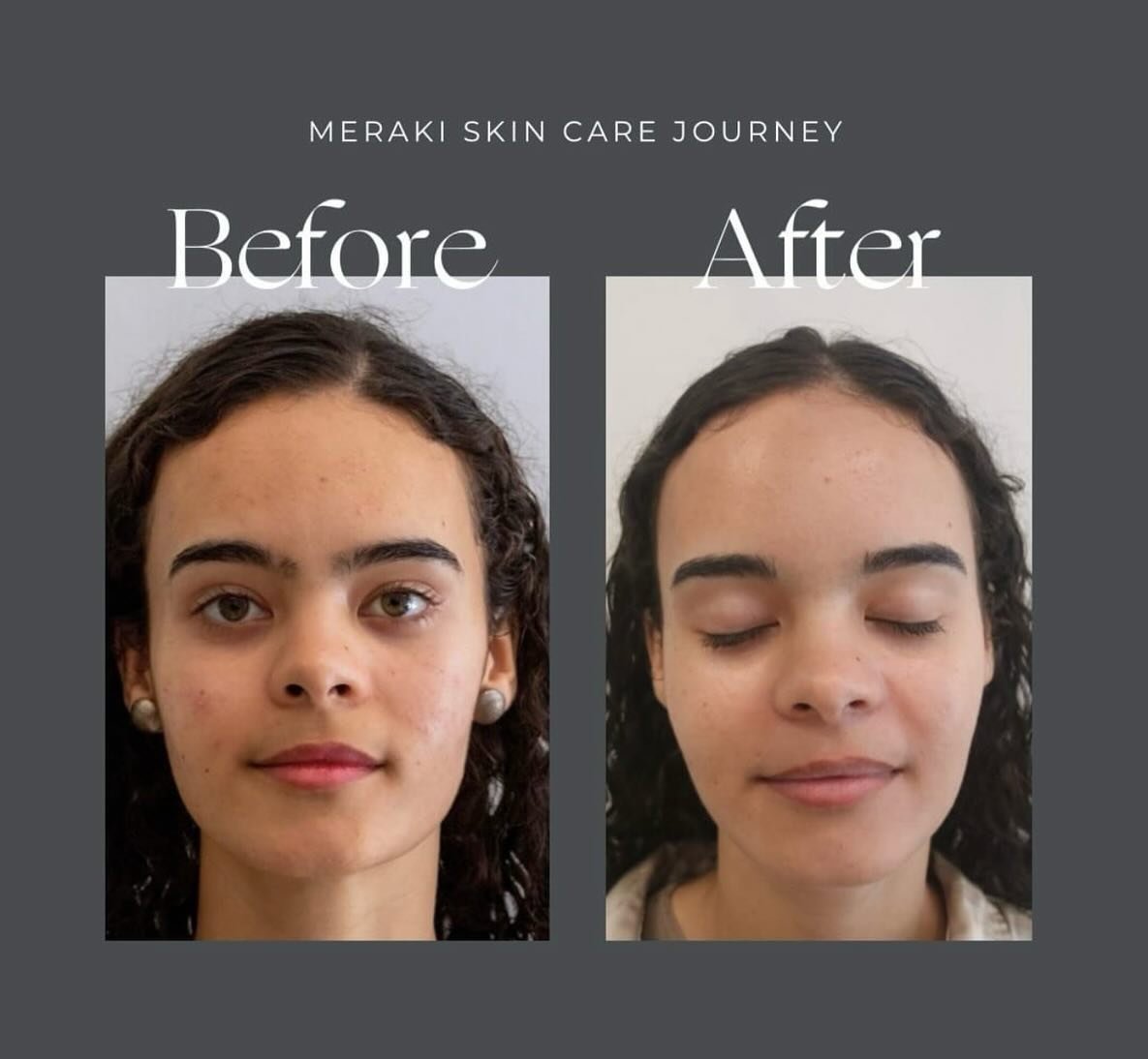 SWIPE to see Meraki&rsquo;s Skin Care Journey 👉 with our Recovery Treatment you can restore your skin&rsquo;s natural radiance. Say goodbye to blemishes, dullness, and irritation as we rejuvenate and revitalize your complexion. Embrace the glow of h