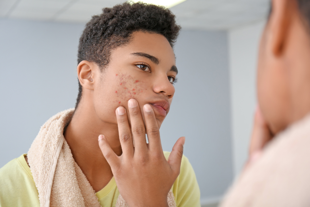 Young man with acne breakouts examines his cheek in mirror while wearing towel around neck
