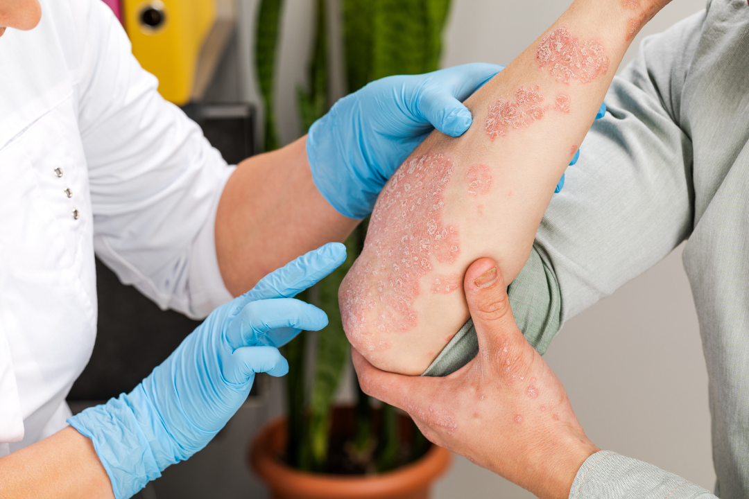 World Psoriasis Day: Why Psoriasis Flares in Fall and How an Asheville Dermatologist Can Help