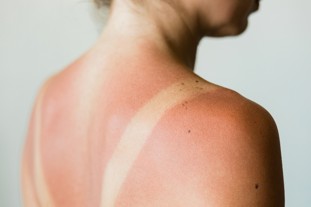 What to Do When You Get a Sunburn: Advice from an Asheville Dermatologist