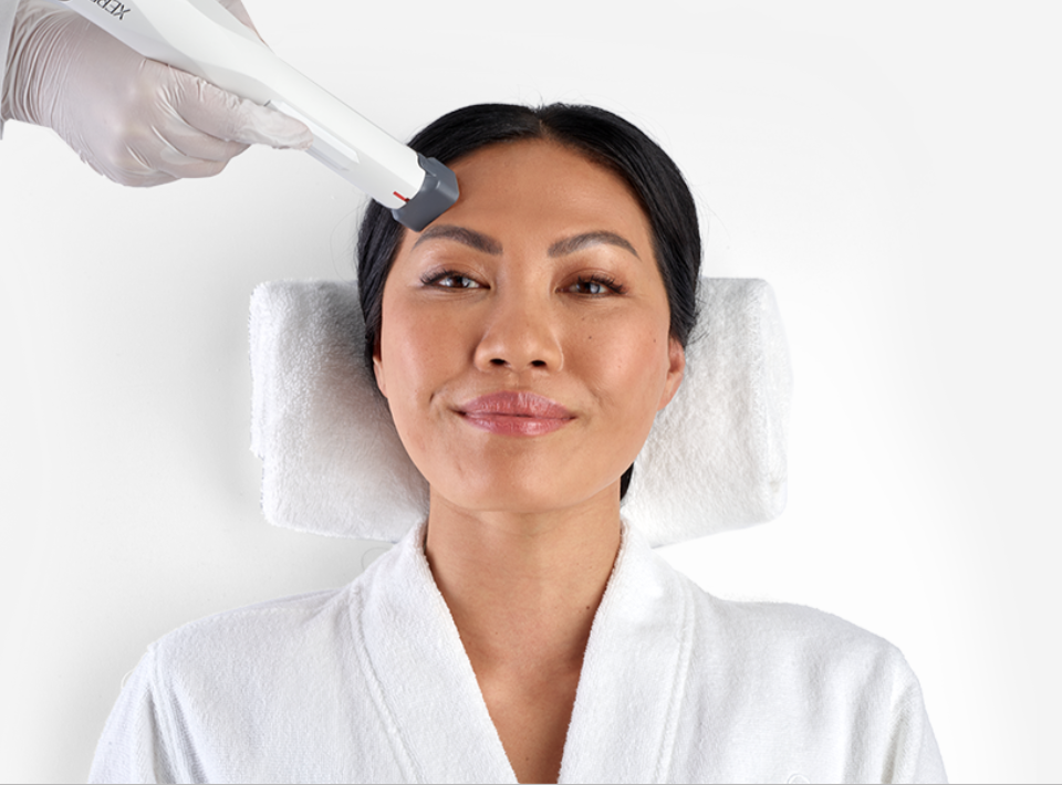 Woman Receiving XERF Treatment on Forehead