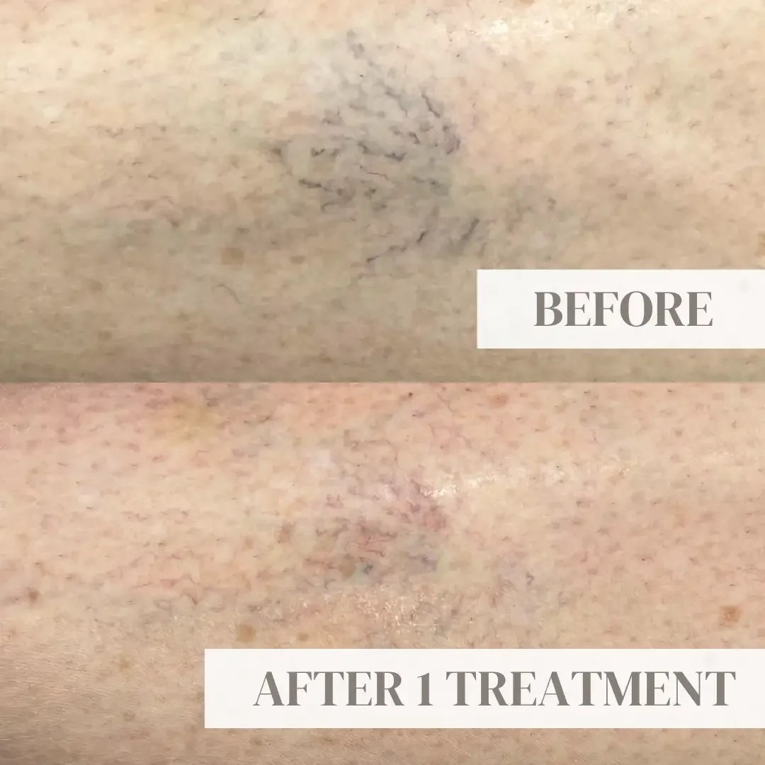 Vein Treatment