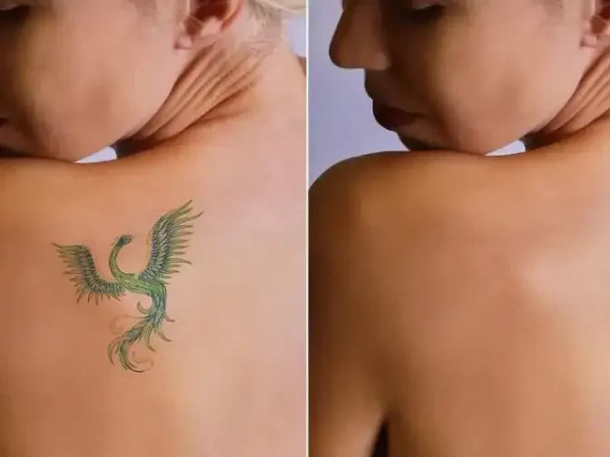 Tattoo Removal