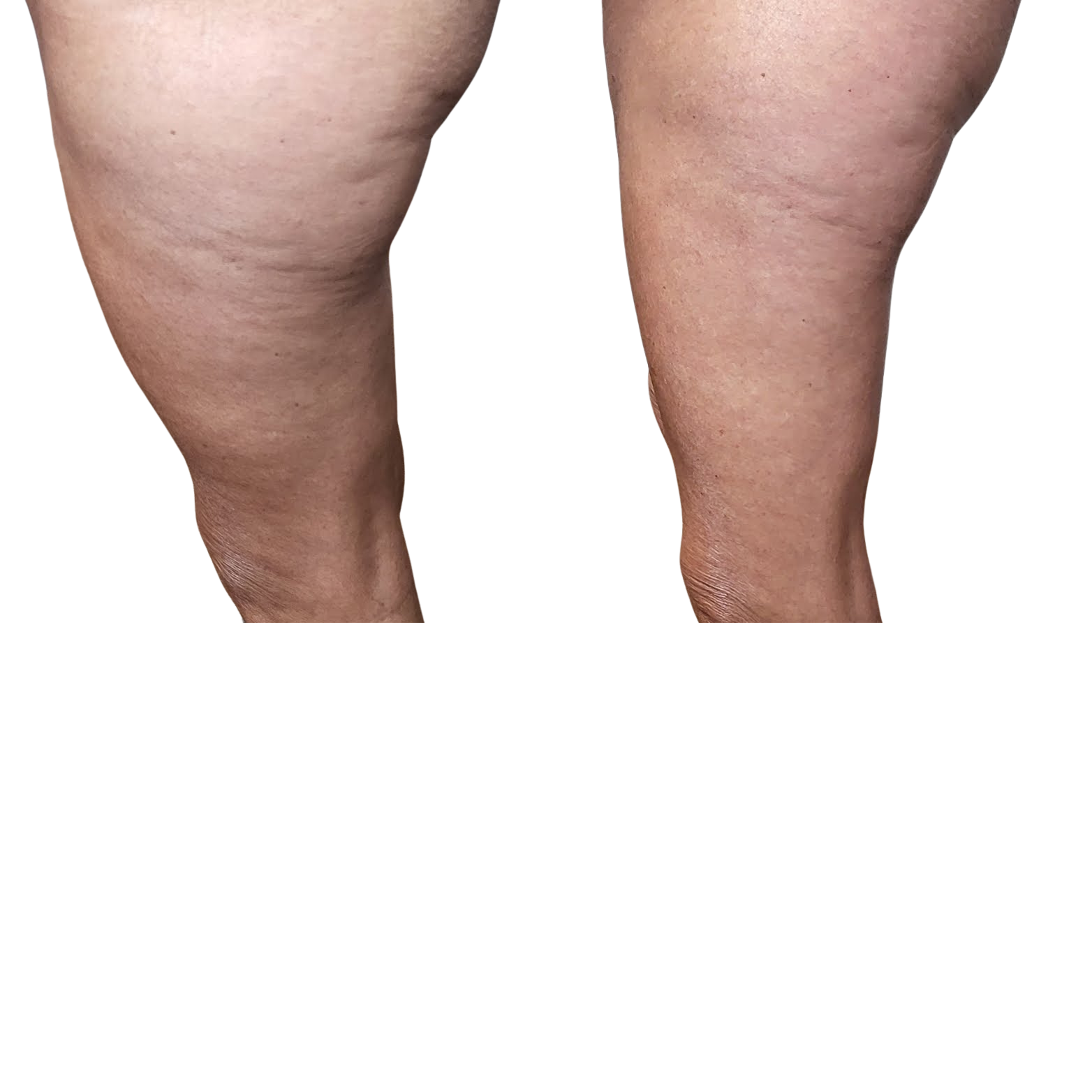 cellulite 2.1.png
