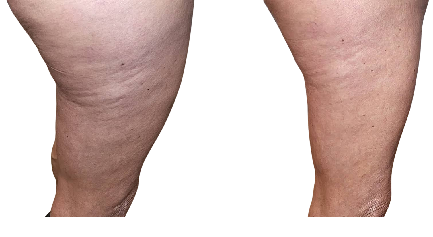 cellulite.png