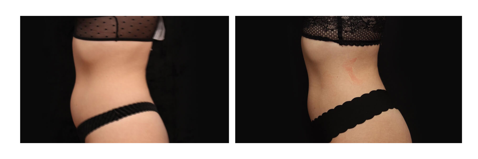 After 1 truSculpt treatment and 4 truFlex treatments