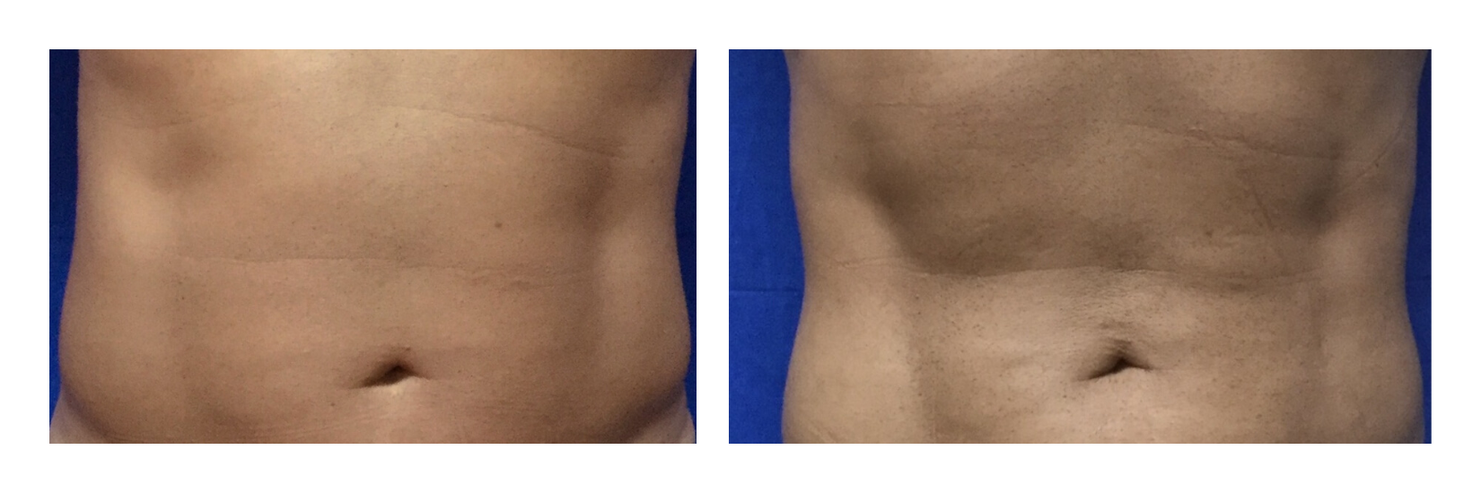After 1 truSculpt treatment and 4 truFlex treatments
