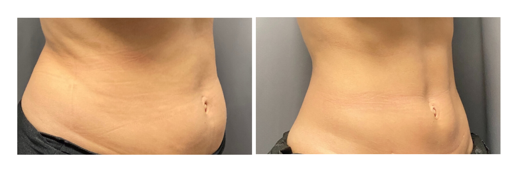 After 1 truSculpt treatment and 4 truFlex treatments