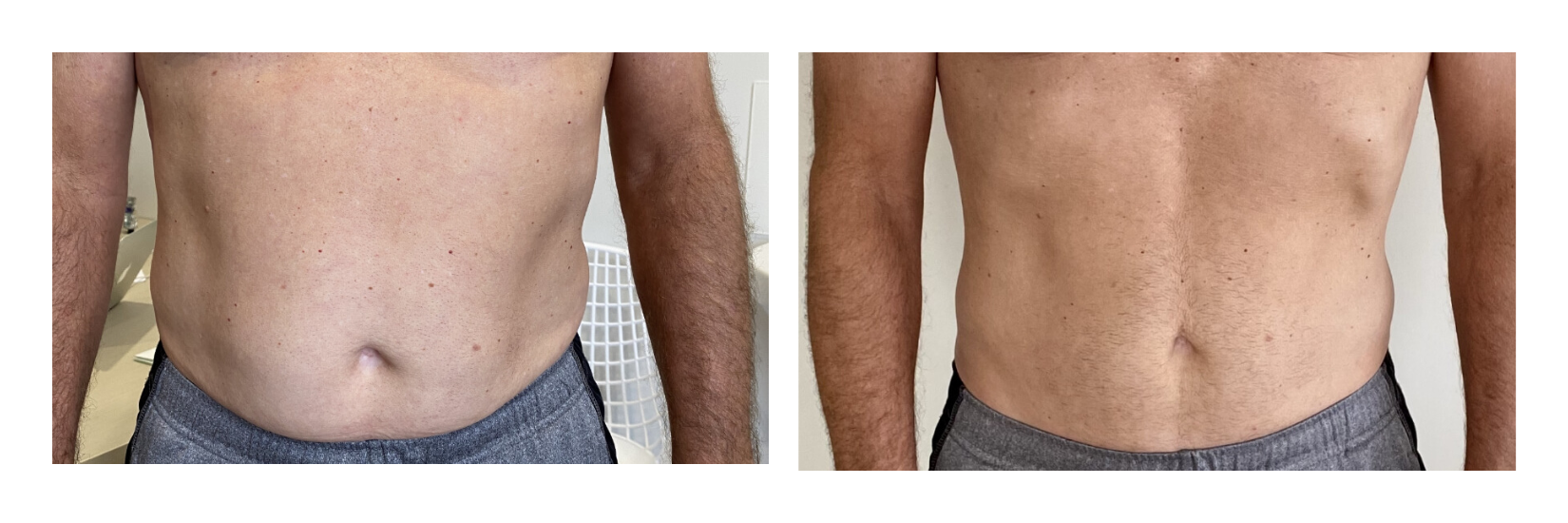 After 1 truSculpt treatment and 4 truFlex treatments