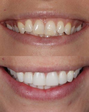  Pilt 4. Viltused ja värvi muutnud hambad, ruumipuudus, väikese kujuga lateraalid. Ortodontia-valgendamise-komposiidiga taastamise protokoll enne ja pärast.  [1]    &nbsp; 