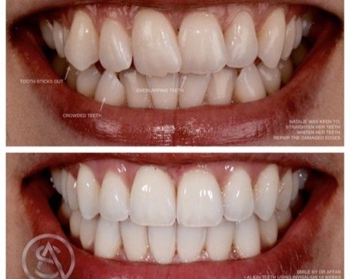  Pilt 3. Ülemistel ja alumistel hammastel ruumipuudus ja kulumine, parem silmahammas turritab välja. Ortodontia-valgendamise-&nbsp;&nbsp;komposiidiga taastamise protokoll enne ja pärast.  