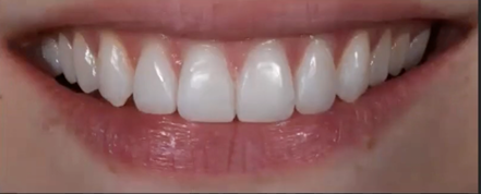  Pilt 5. Esihambad üksteise peal, puseriti, ebaühtlase kujuga ja kulunud hambad. Ortodontia-valgendamise-komposiidiga taastamise protokoll enne ja pärast. 