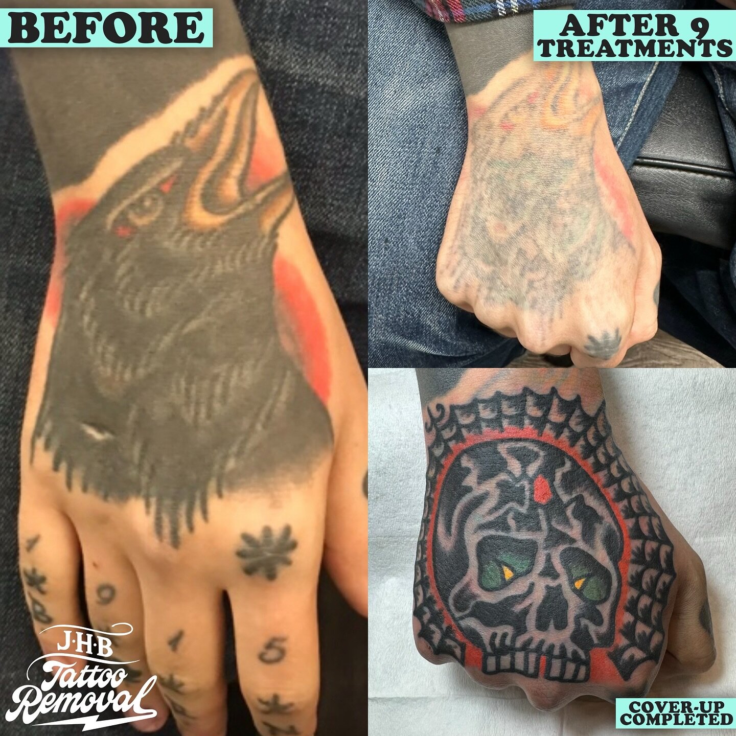 @nickylatt is one of the few people on this plant 🌍 to have had 4(I think) full hand tattoos! We removed this coverup tattoo down ready for another coverup by @bertkrak at @smithstreetrodandgunclub 
Nicky finally has a hand tattoo he loves and I&rsq