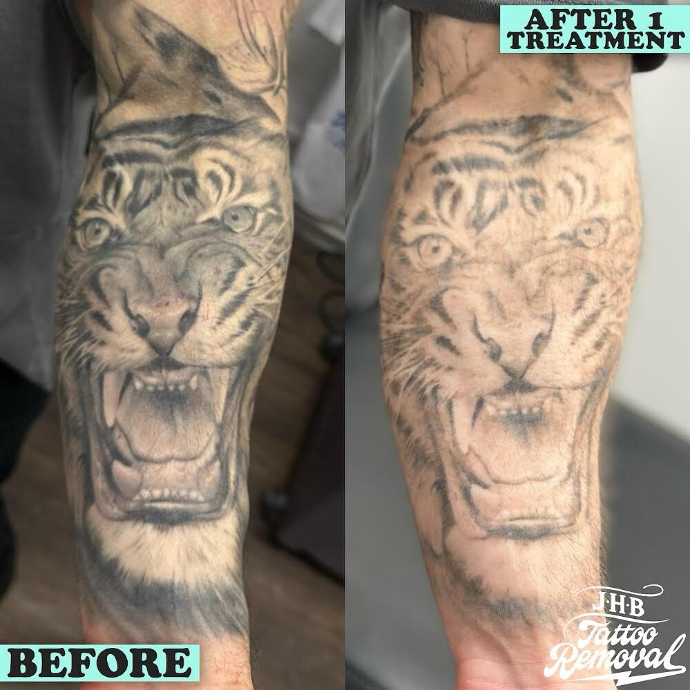 Rapid fading on this piece for P! 🏃 You&rsquo;re looking at 4-12 weeks of fade after first treatment on this. ⚡️ 

#peterborough #cambs #norfolk #cambridgeshire #wisbech #ely #march #huntingdon #cambridge #tattoos #ink #kingslynn #stamford #oakham #