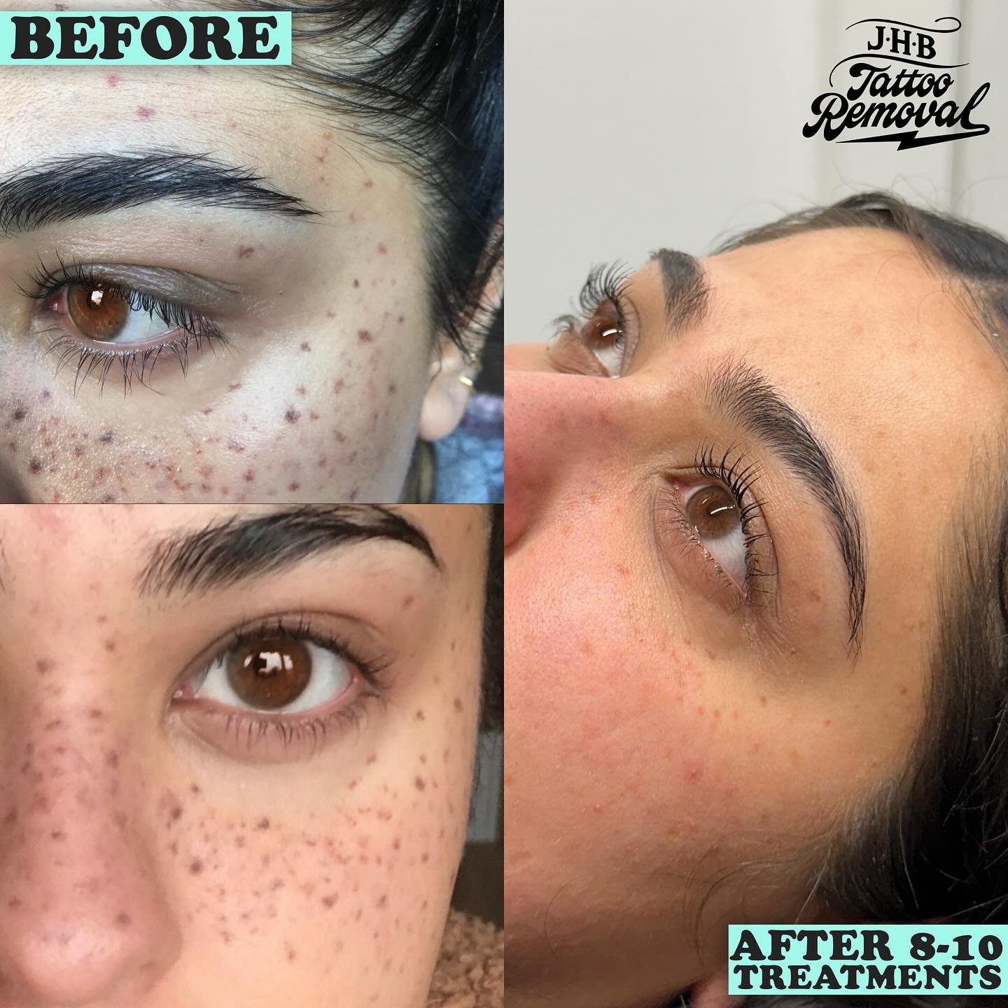 This has to be one of my favourite projects in recent memory. This lady came to me, not happy with her tattooed freckles at all.   Now, when it comes to treating darker skin types that have red/orange pigments in them&hellip; that&rsquo;s usually a n