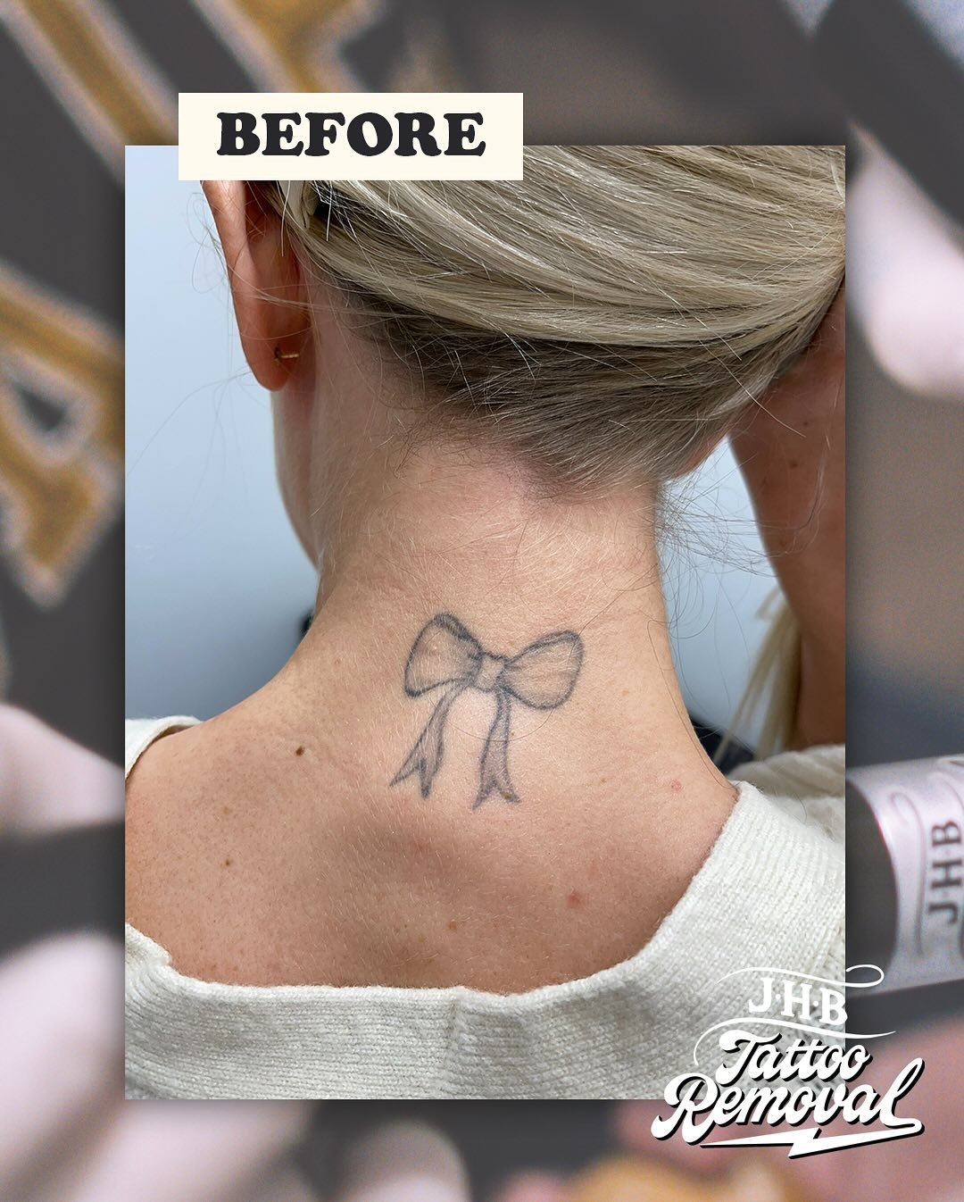 Love, love, love this Result for the awesome and dedicated K! What a legend. This tattoo wasn&rsquo;t the main focus, we&rsquo;re actually removing another on her that&rsquo;s taking a while longer. We decided to treat this one a little more sporadic