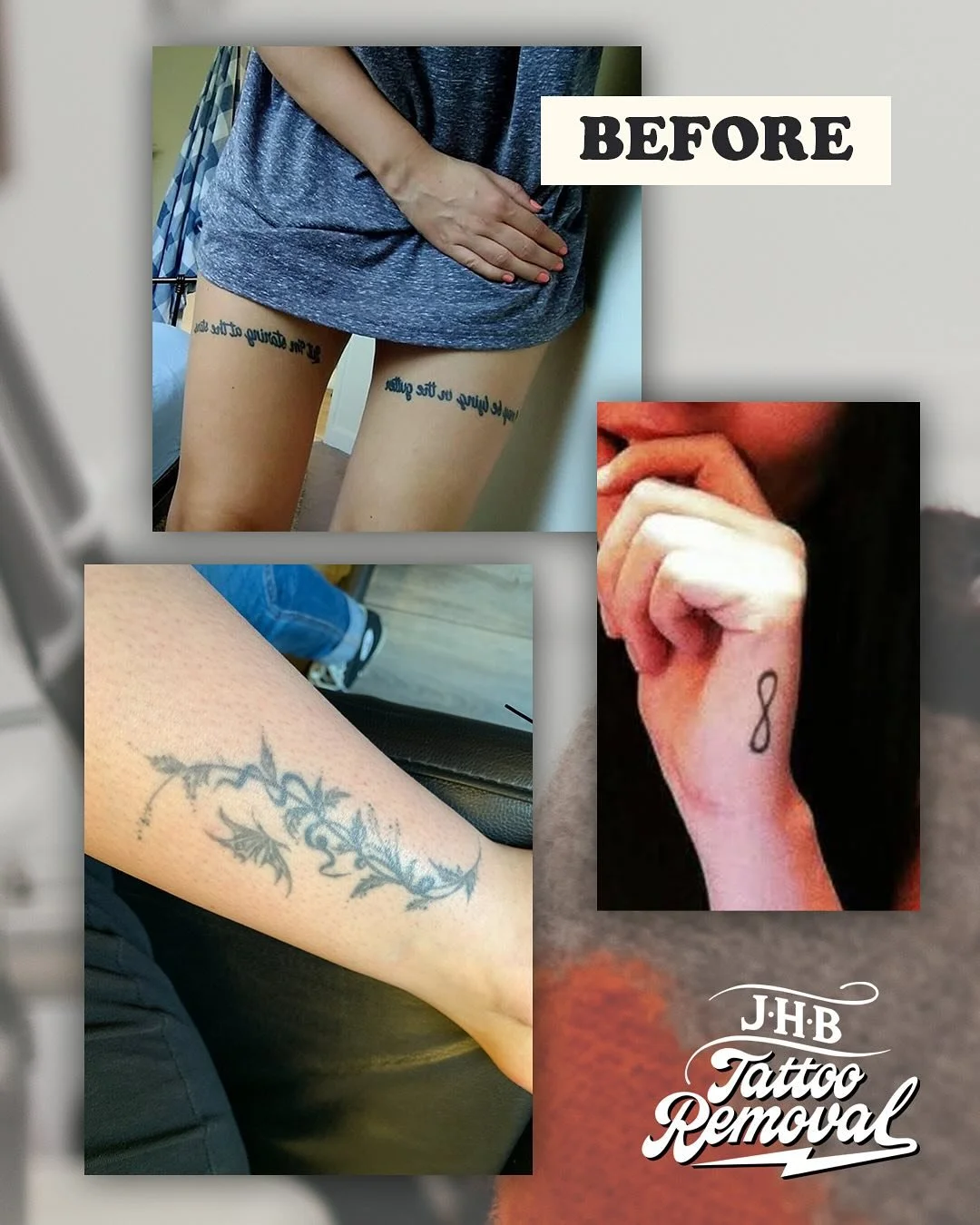 What a journey it has been @go_ellie ! 🙏 We removed 3 tattoos in total! Friend 4 lyf right here. 
The writing on her leg was incredibly scarred unfortunately. We had to slow down a little and really utilise the time between treatments to help with