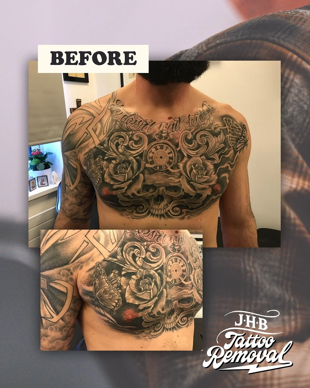 B came to me when his tattoo was just 6 months old. I always treat a touch more cautiously when something new comes through the door as the skin has a habit of being over-responsive to the treatments. So, it’s taken a little longer than anticip