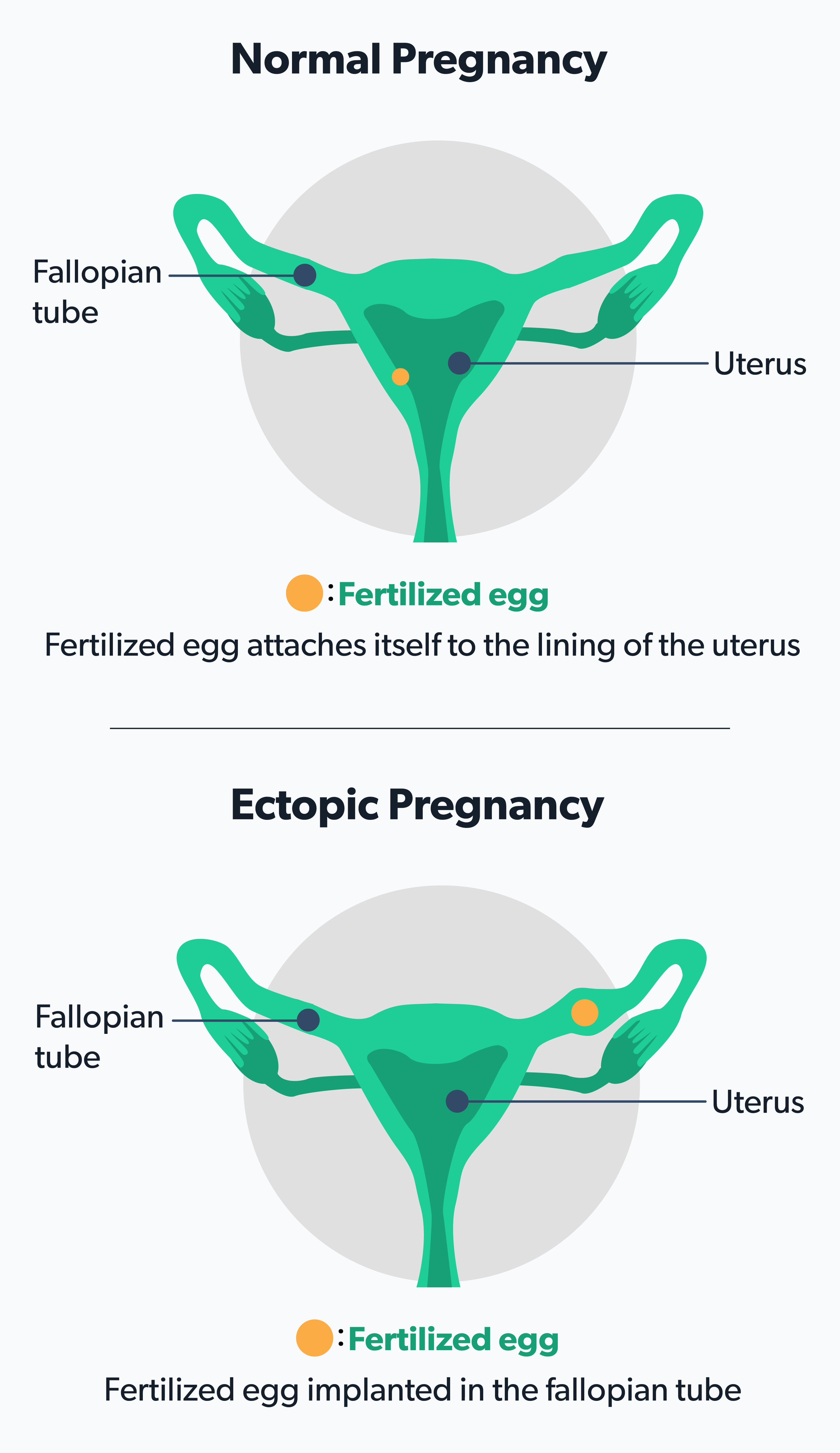 Ectopic+Pregnancy.png