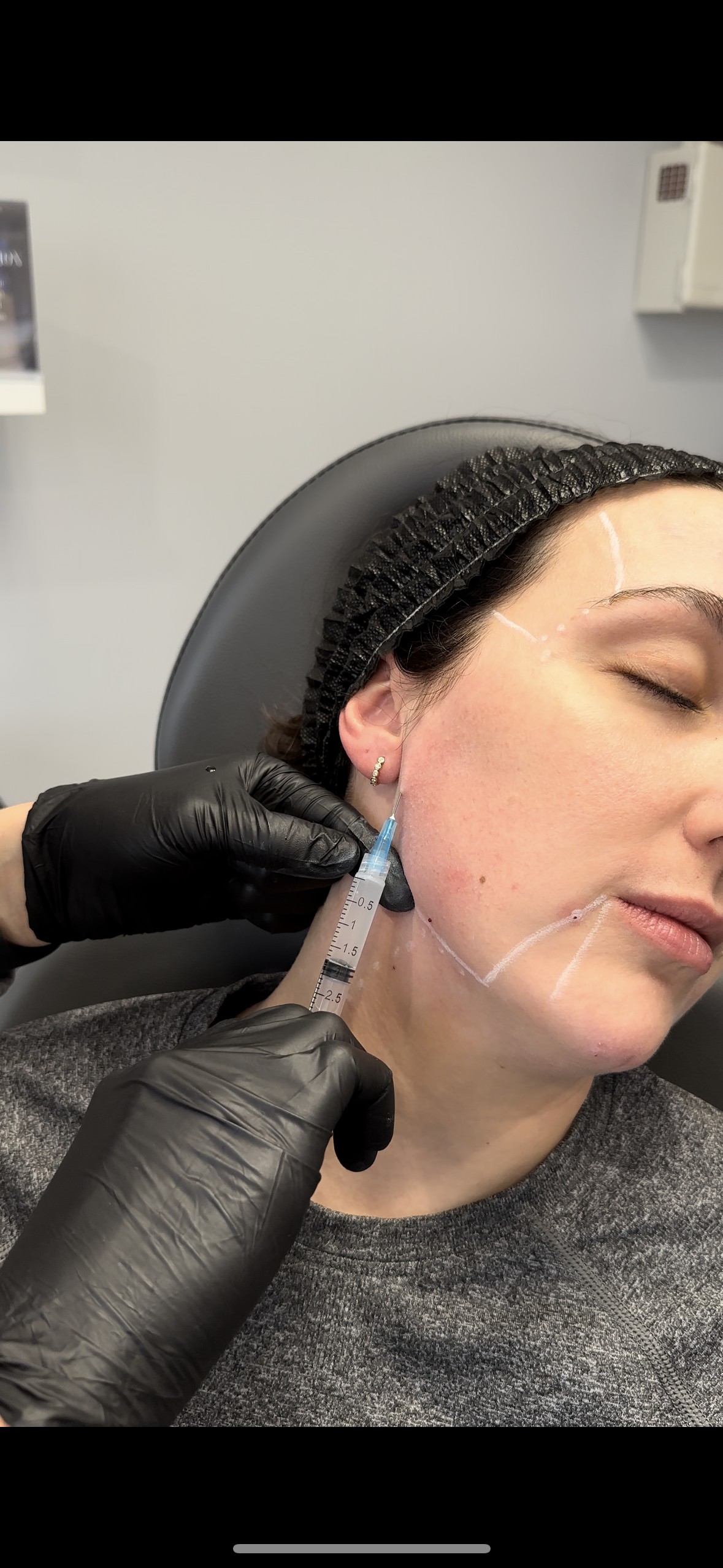 Sculptra vs. Filler: Which Is Right for You?