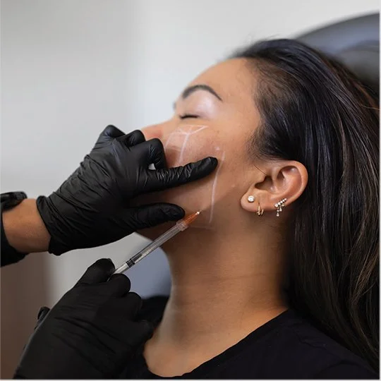 Sculptra treatment