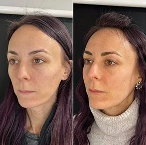 before an after Sculptra