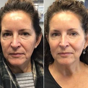 before an after Sculptra results