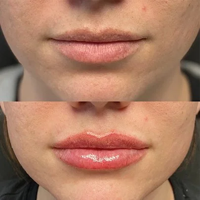 Fillers