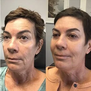 before an after Sculptra results