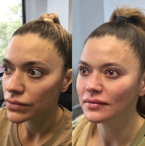 Sculptra results