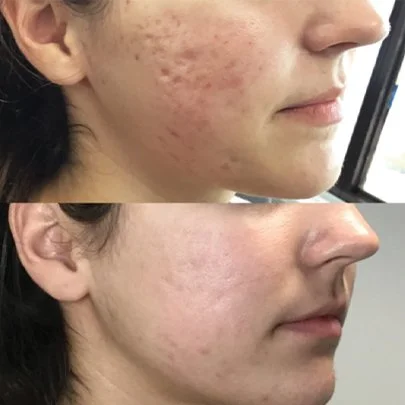 MICRONEEDLING