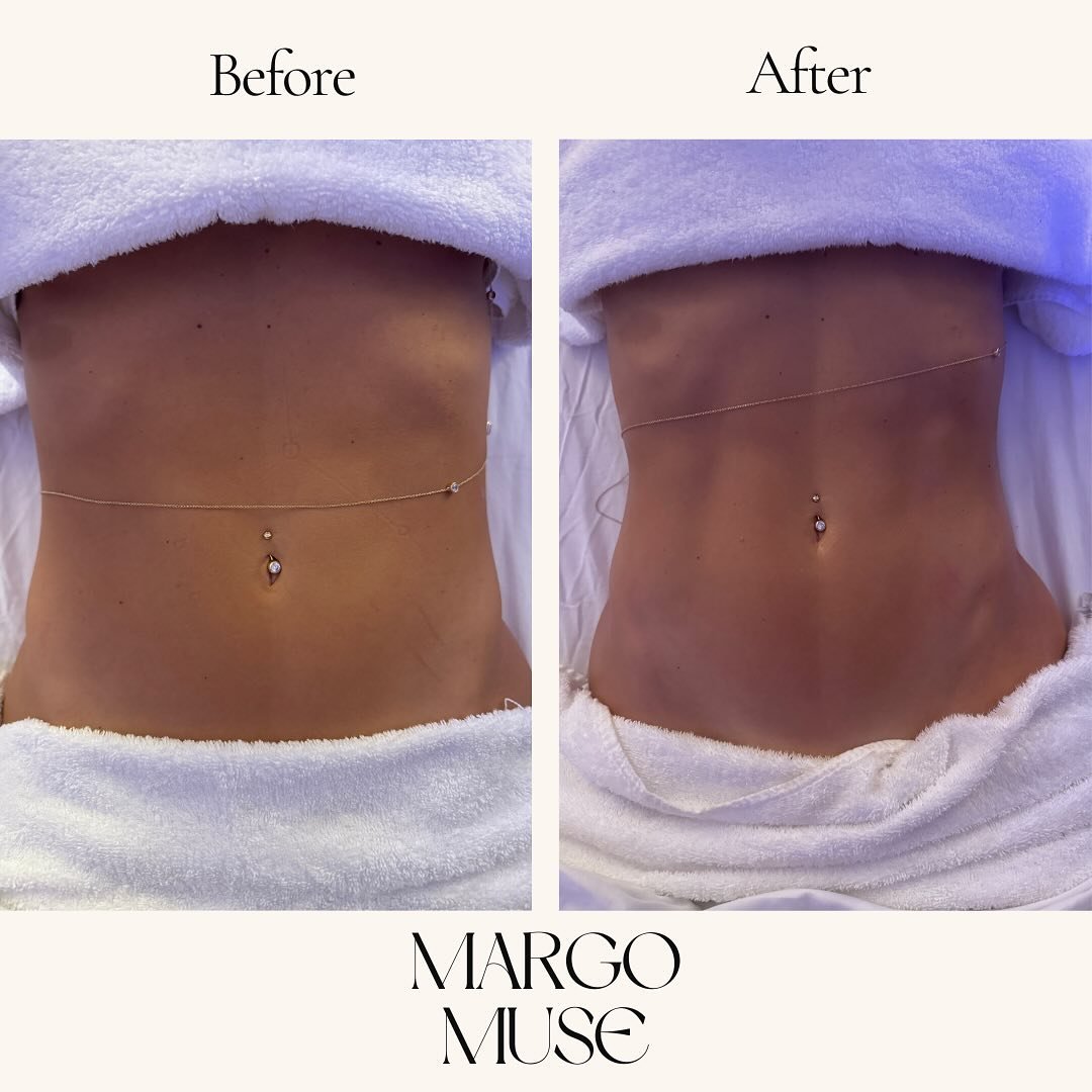 No better feeling. The visual results are just a bonus to the many benefits within ✨

DM us with any questions &amp; book at the link in bio 

#lymphaticmassage #lymphaticdrainage #woodtherapy #detox #bloat #woodtherapymassage
#massage #beauty #healt