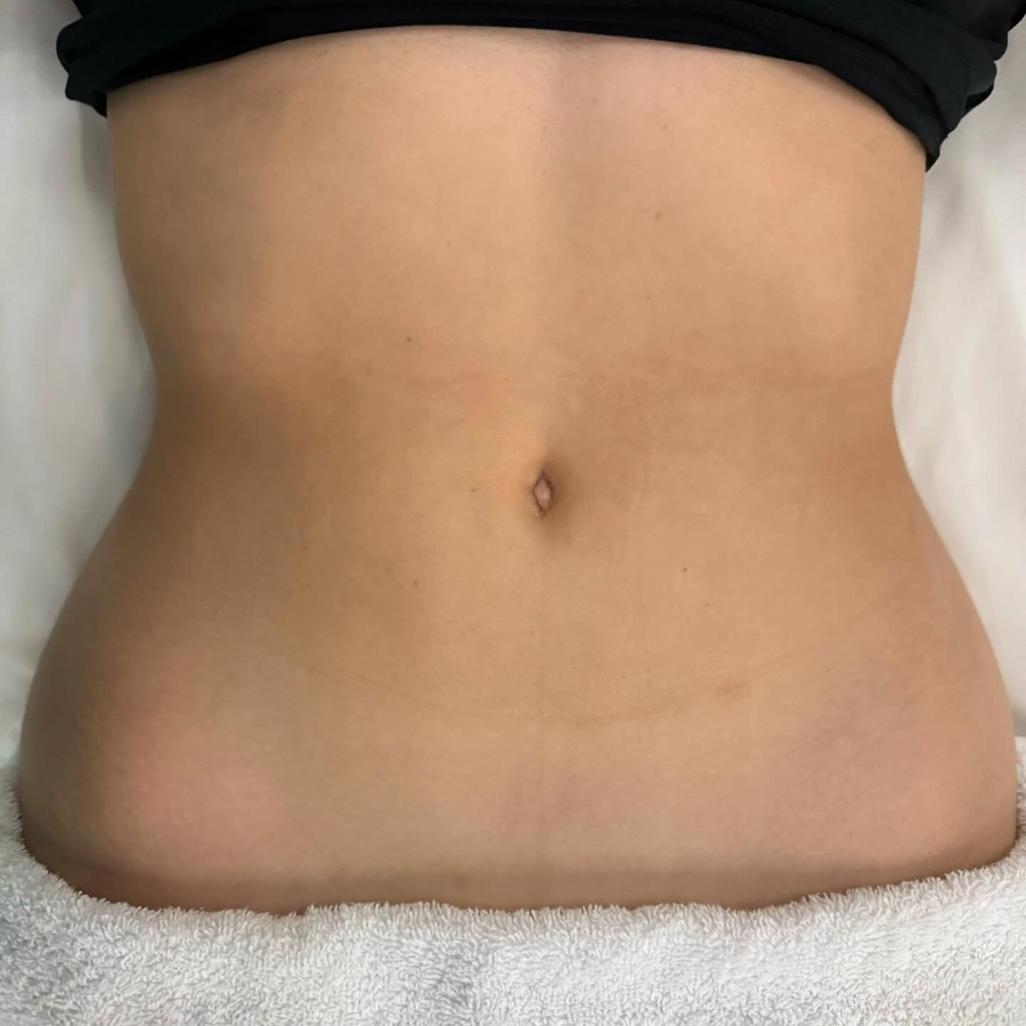Swipe to see one of the many benefits of lymphatic drainage. Aside from the visual results, this technique helps to stimulate your lymphatic system, promoting detoxification, reducing swelling, and enhancing circulation. Say goodbye to bloating and h