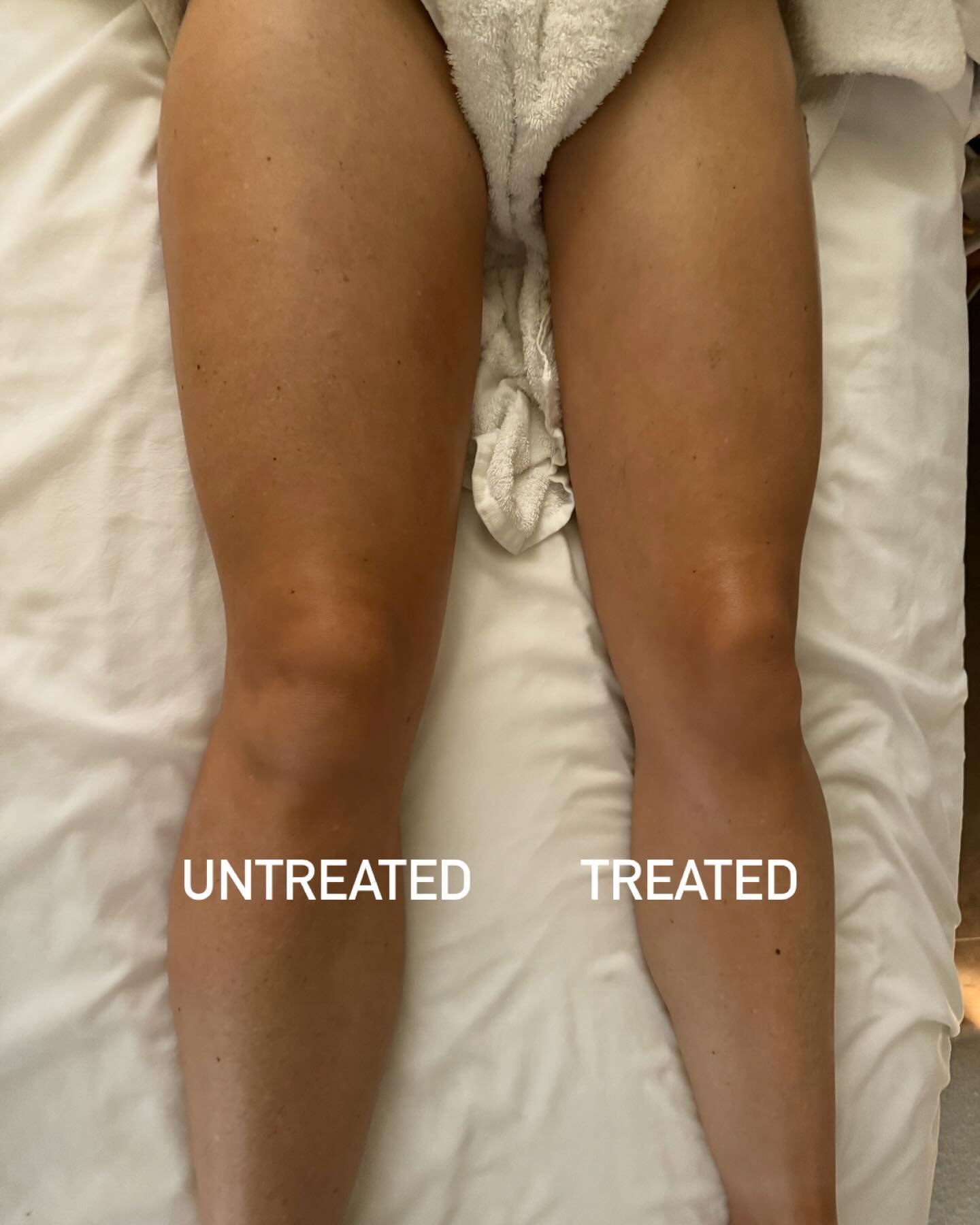 We love the magic of lymphatic drainage on the legs! This treatment stimulates the lymphatic system, flushes toxins, rids the body of excess water retention, increases circulation, boosts the immune system, and can further break down fat and cellulit