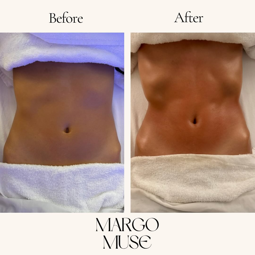 Nothing better than the feeling after a lymphatic drainage treatment. A combination of multiple techniques are used in one session which are pivotal in stimulating the lymphatic system, eliminating toxins, reducing bloat, ridding the body of excess w