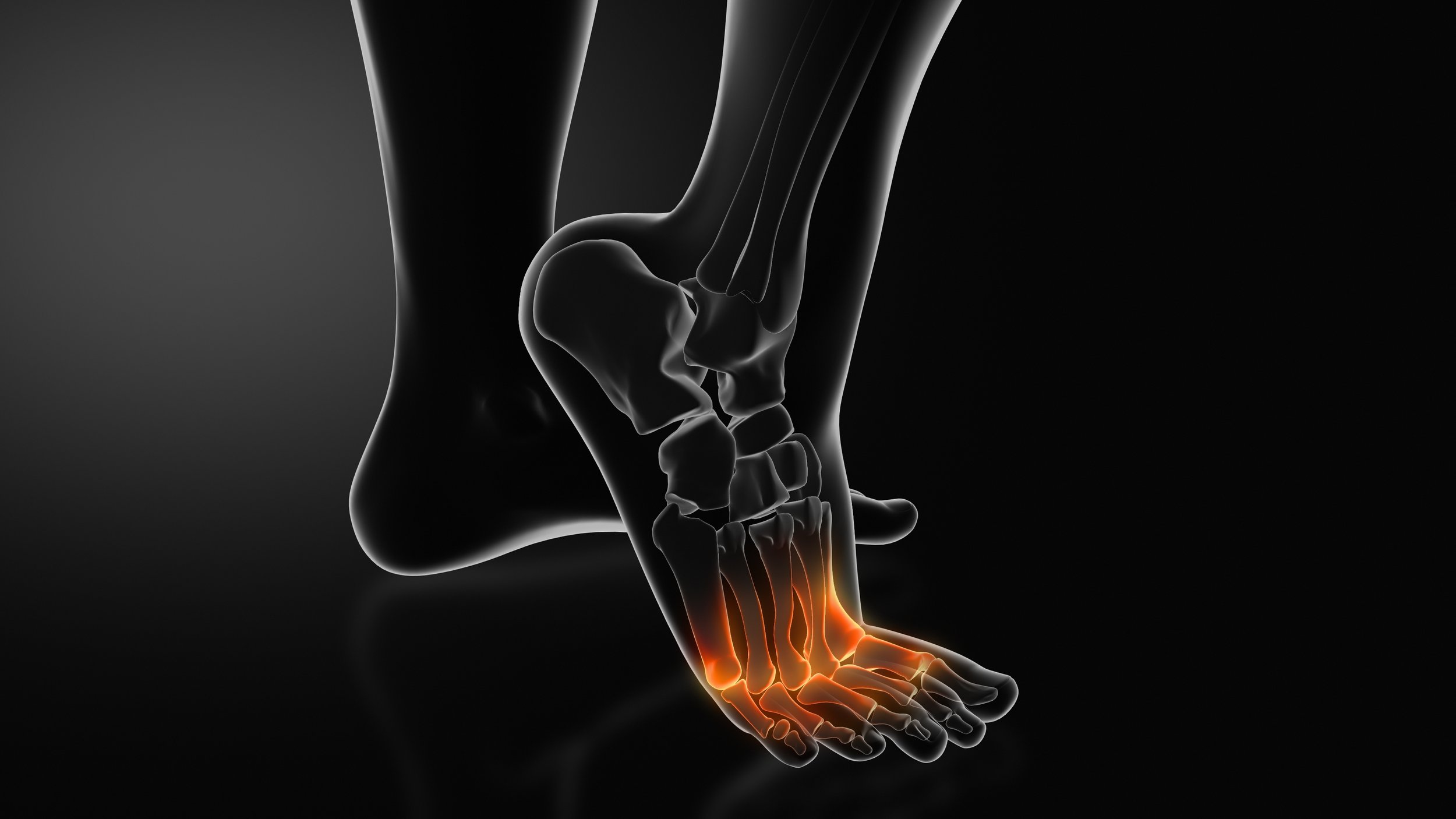 What Is Metatarsalgia? A Podiatrist Explains Symptoms, Causes, and Treatments for this Cause of Foot Pain