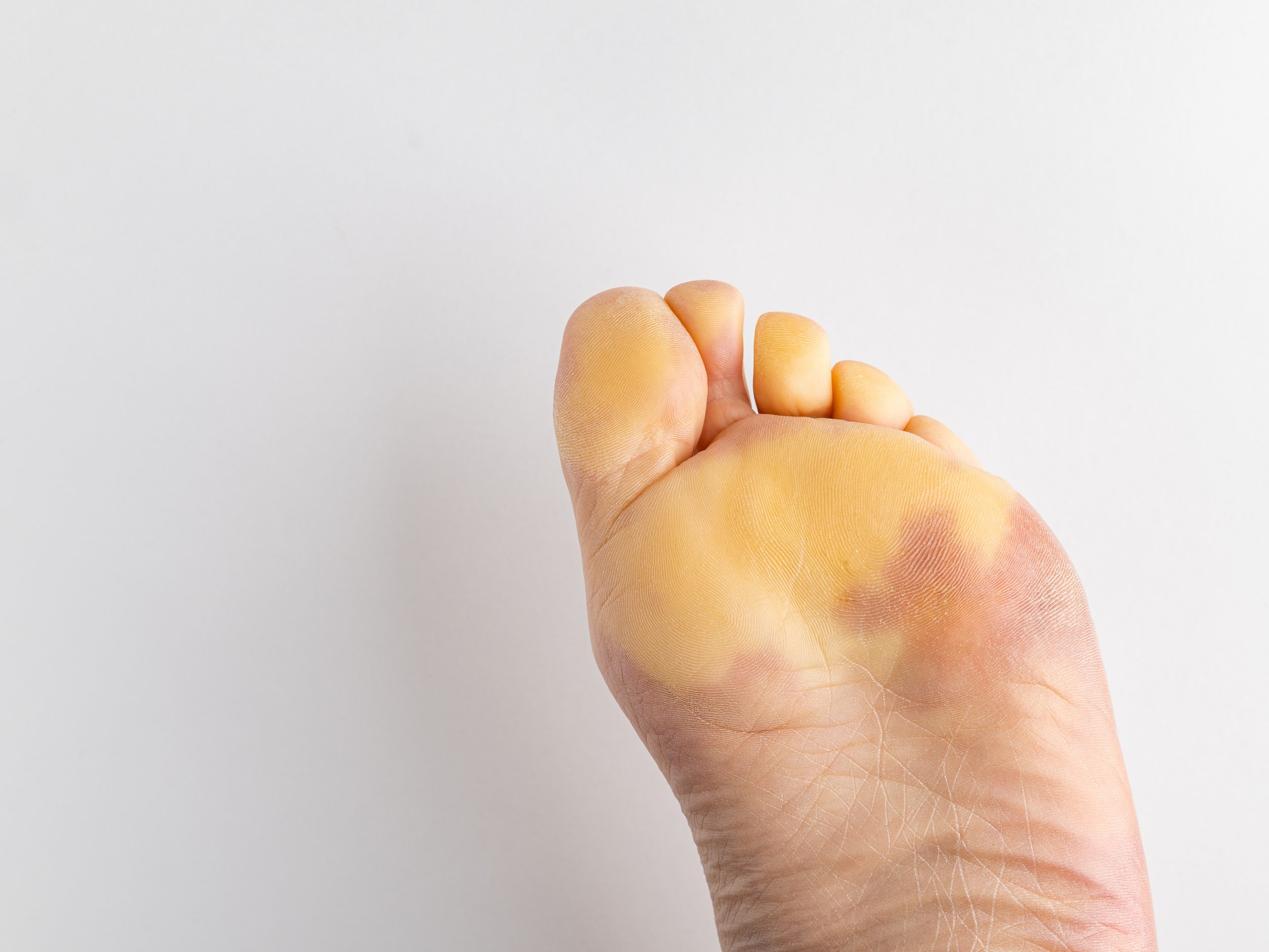 Raynaud’s in the Feet: Symptoms, Cold-Weather Triggers, and How to Protect Your Toes