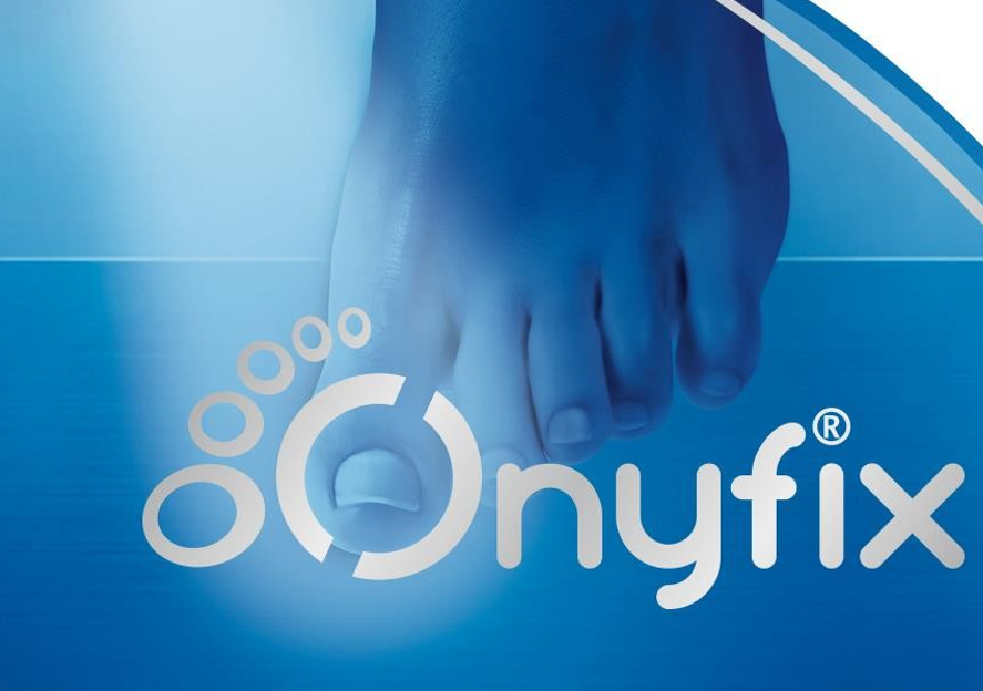 A Pain-Free Way to Treat Ingrown Toenails: How Onyfix Helps Your Nail Grow the Right Way