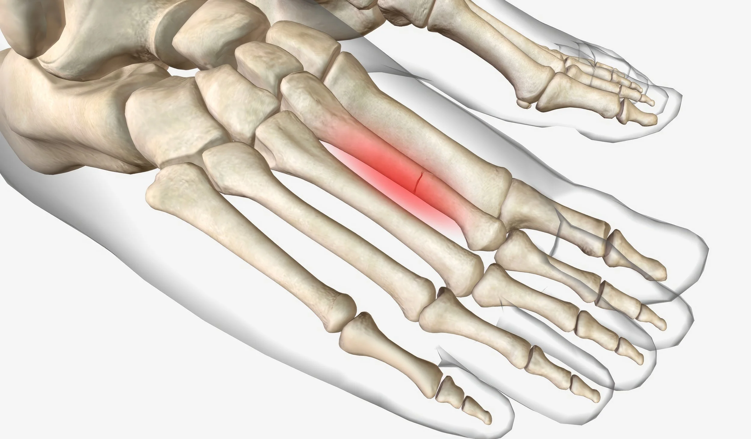 Stress Fractures in the Foot: Early Signs, Causes, and Why They're Easy to Miss
