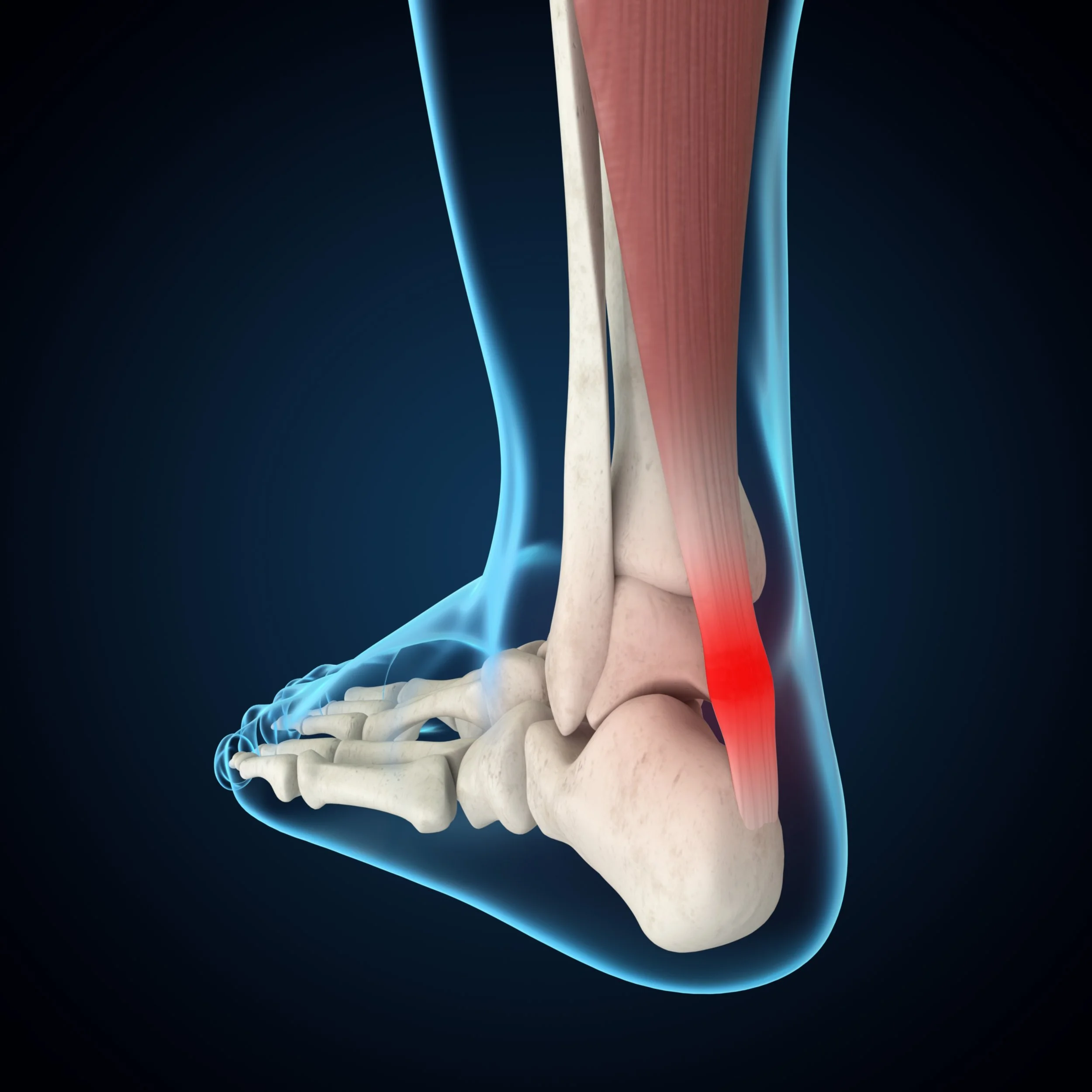 Achilles Tendonitis: Why It Happens, Why It Lingers, and What Actually Helps