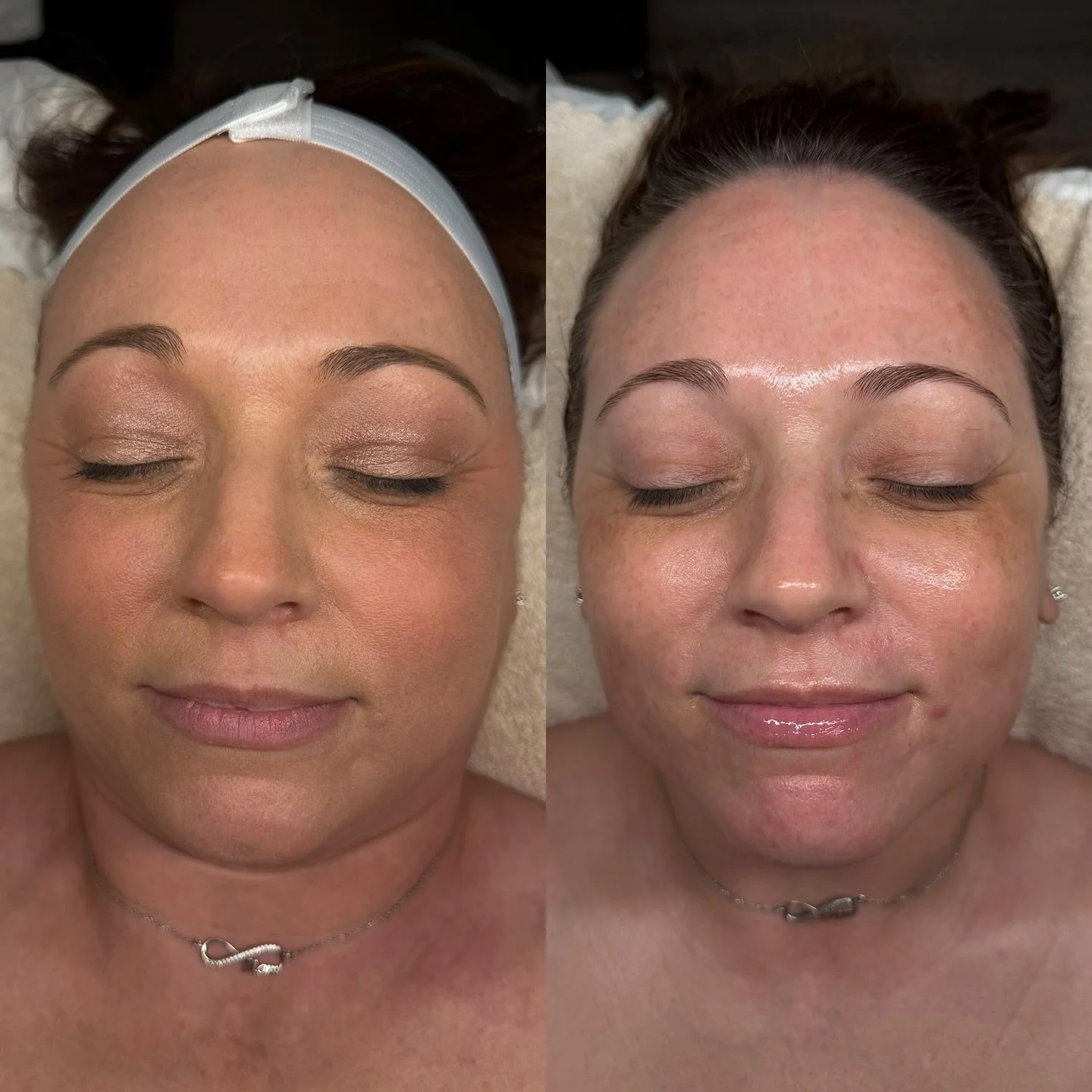 Snatched and glowing🌸

Manual tissue manipulation during a facial is so important. No matter what you book with Wild Bliss we focus on proper flow to increase circulation and lymphatic drainage💧

Lymphatic drainage during a facial is a gentle, rhyt